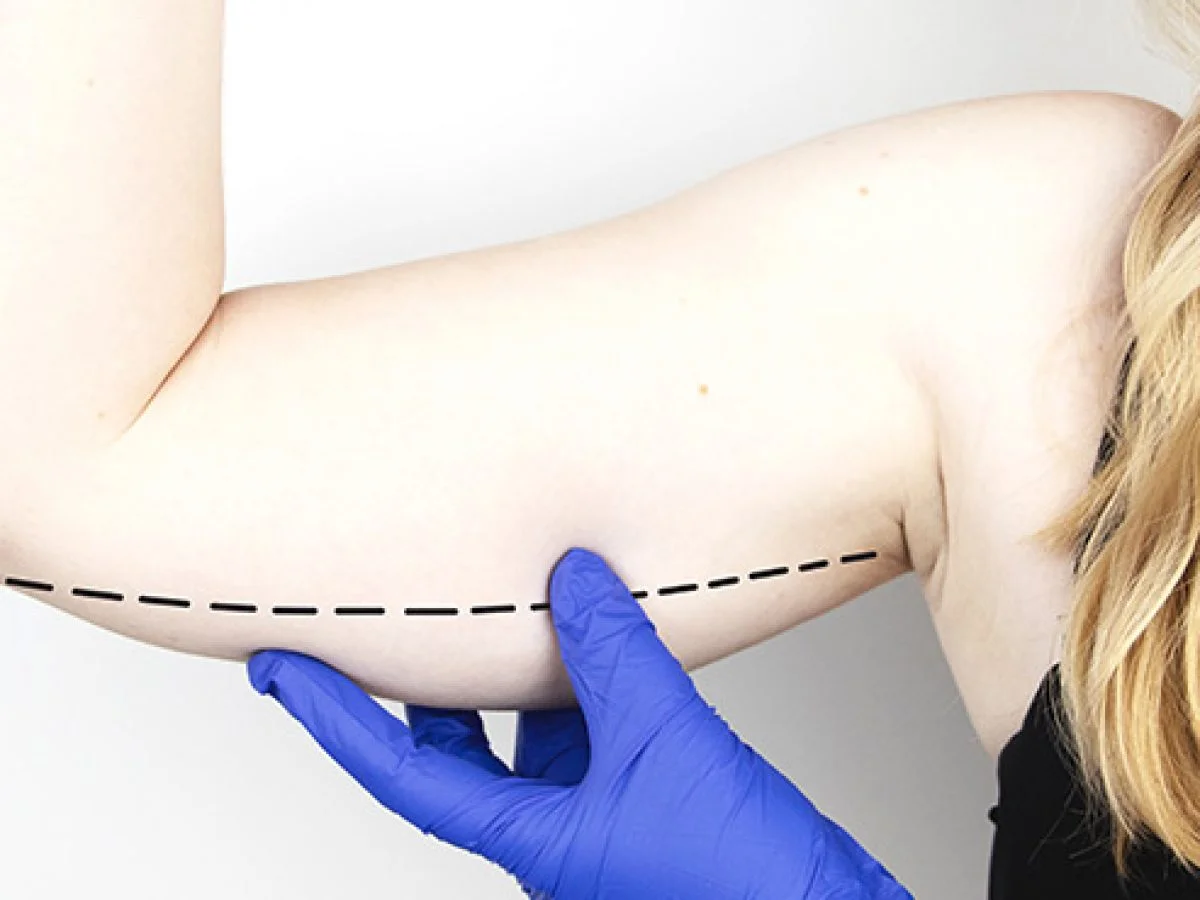 Foto de A before and after view of a successful brachioplasty procedure. An  untoned arm is seen on the left before plastic surgery, and a toned arm is  seen on the right