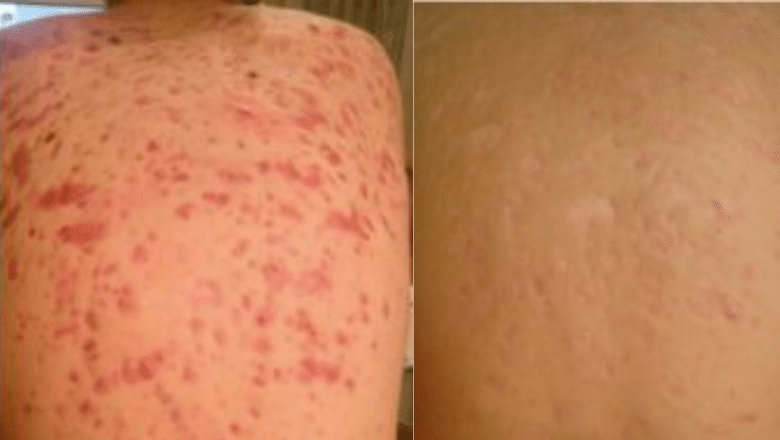 back acne laser treatment before after