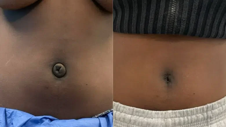 belly-button-correction-before-after.png.webp?format=webp&nv=212368fc-2000-40d1-9026-c0f94abda644