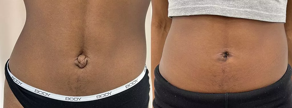 How To Tighten Loose Skin On The Stomach?