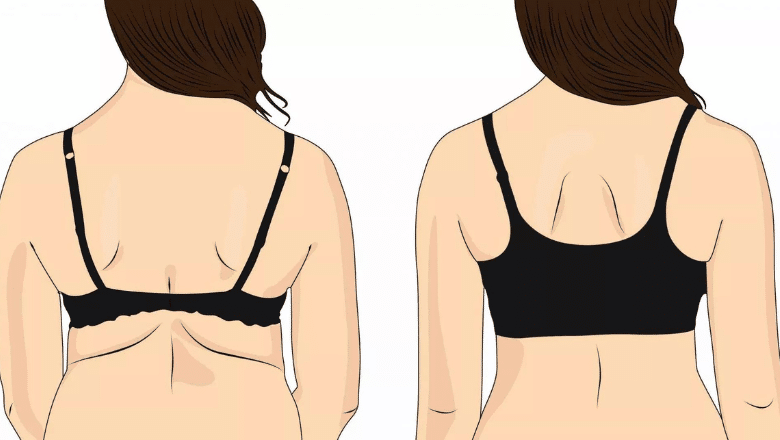 benefits of bra-line back lift surgery