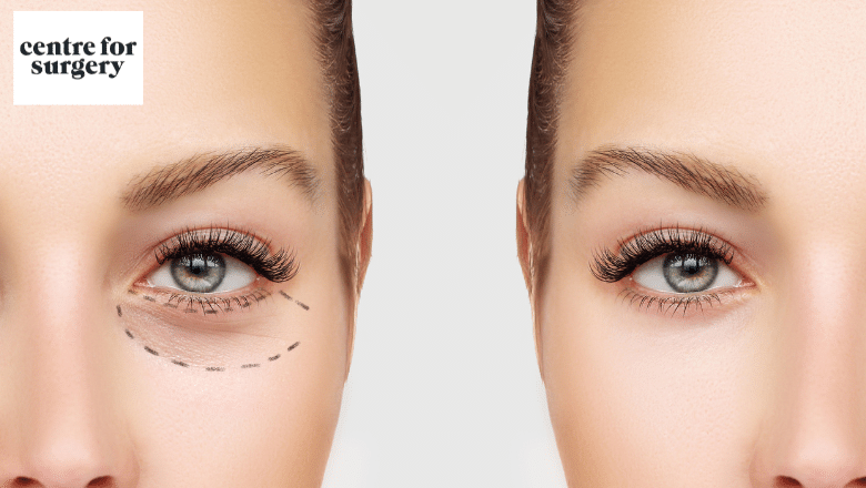 benefits of lower blepharoplasty