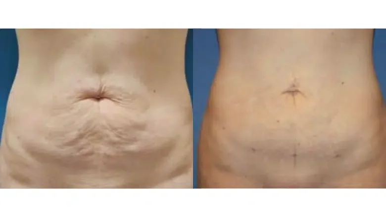 bodytite-abdomen-before-after-1.png.webp?format=webp&nv=212368fc-2000-40d1-9026-c0f94abda644