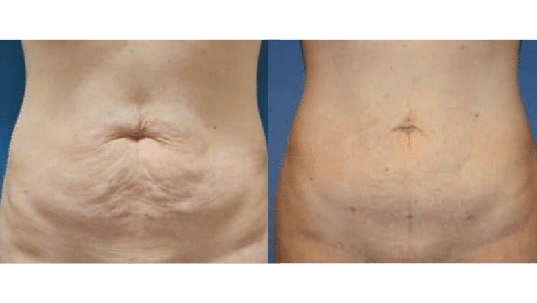 bodytite abdomen before after 1