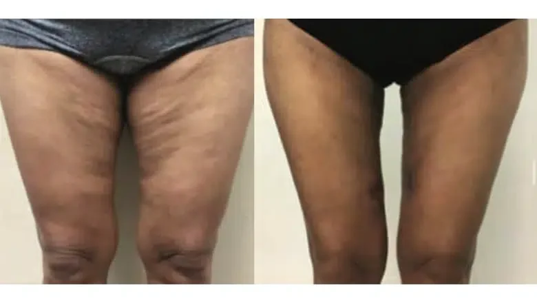 morpheus8 thighs before after 1