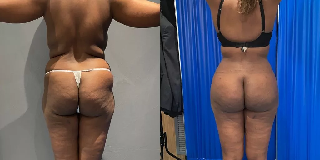 large bmi bbl before and after posterior view
