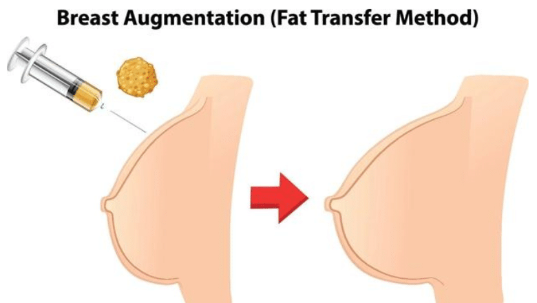 breast augmentation fat transfer london