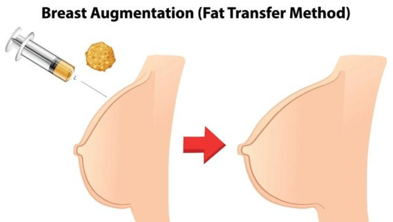 Does Breast Enlargement By Fat Transfer To Breast Last Centre