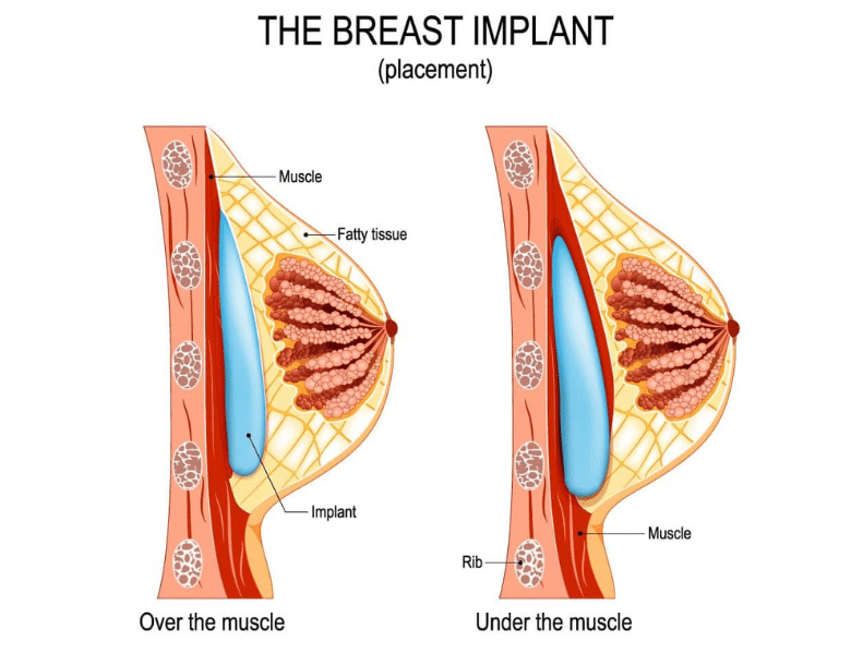 breast implant placement