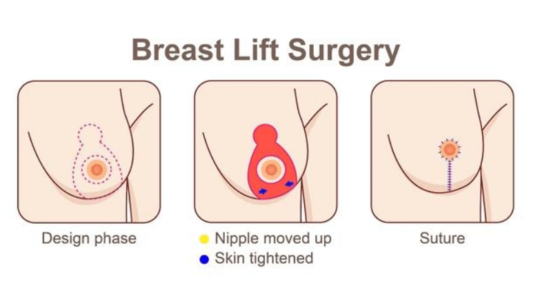 breast lift surgery London