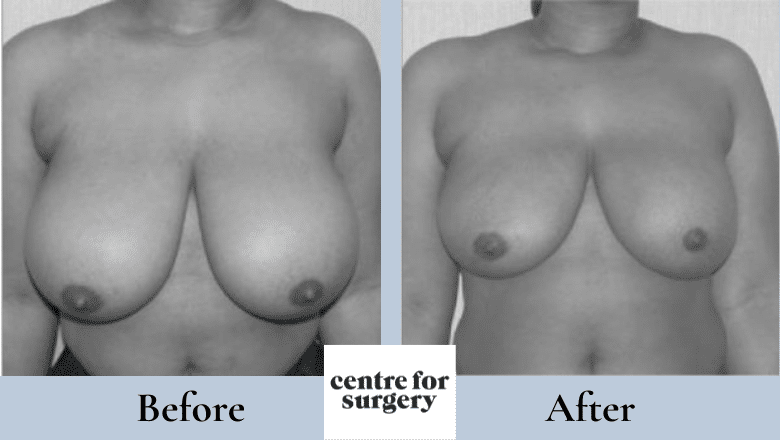 breast liposuction before after 5