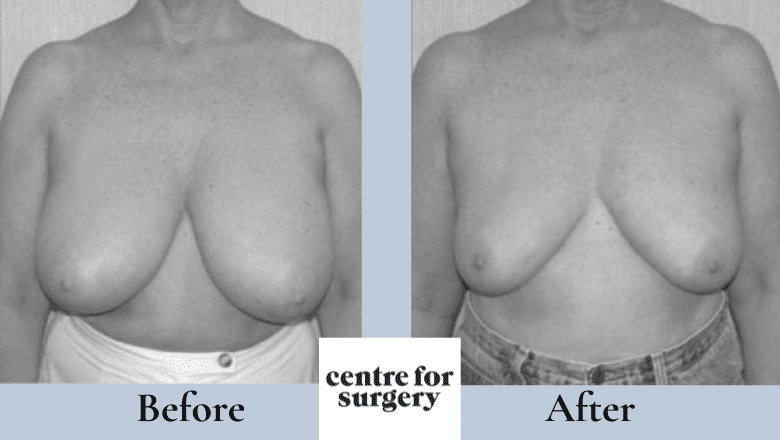breast liposuction before after 6