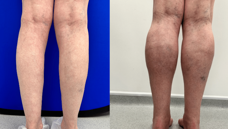 calf fat transfer before after