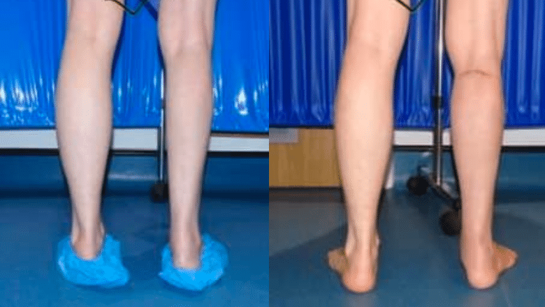 calf implant surgery London before after 9