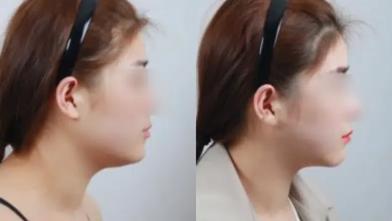 chin-neck-liposuction-before-after-1.png.webp?format=webp&nv=212368fc-2000-40d1-9026-c0f94abda644