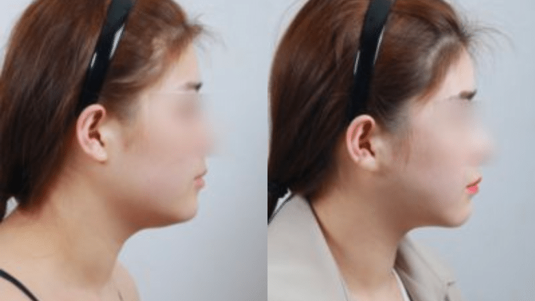 submental liposuction before after