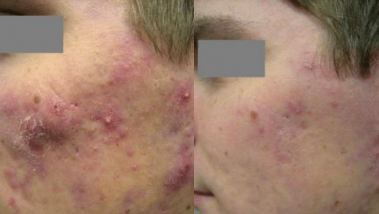 cystic acne laser treatment before after