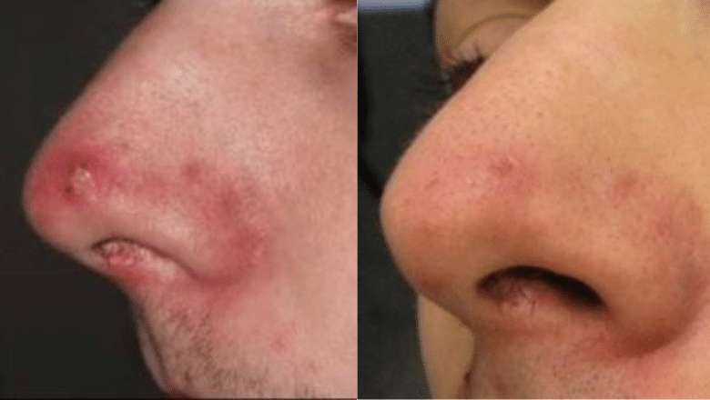cystic acne nose laser treatment before after