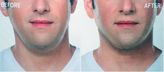 double chin injections before and after frontal view male