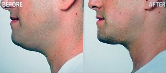 double chin injections before and after profile view male