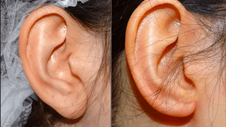 earlobe-reduction-before-after-1.png?for