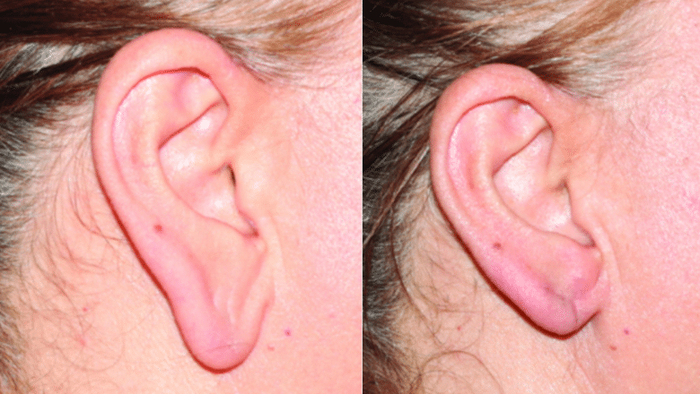 earlobe-reduction-before-and-after-3-1.p