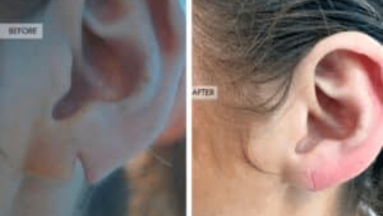 earlobe repair before after 2