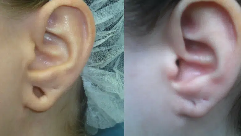 earlobe repair before and after 5