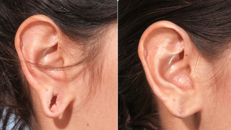 earlobe repair before and after 7