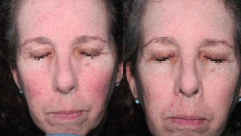 face laser rosacea treatment before after