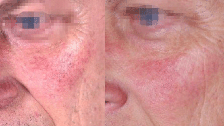 face thread veins laser removal before after