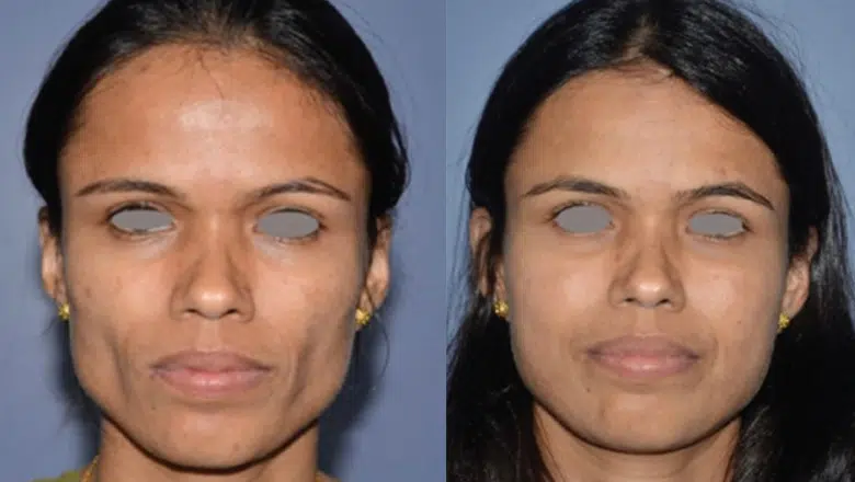 facial fat transfer before and after 