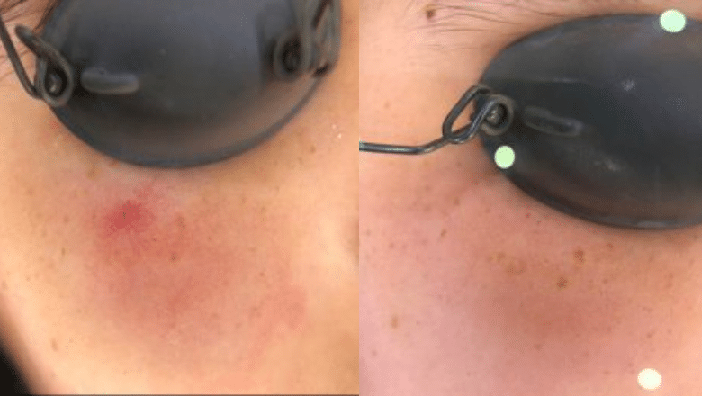 facial thread vein laser removal before after