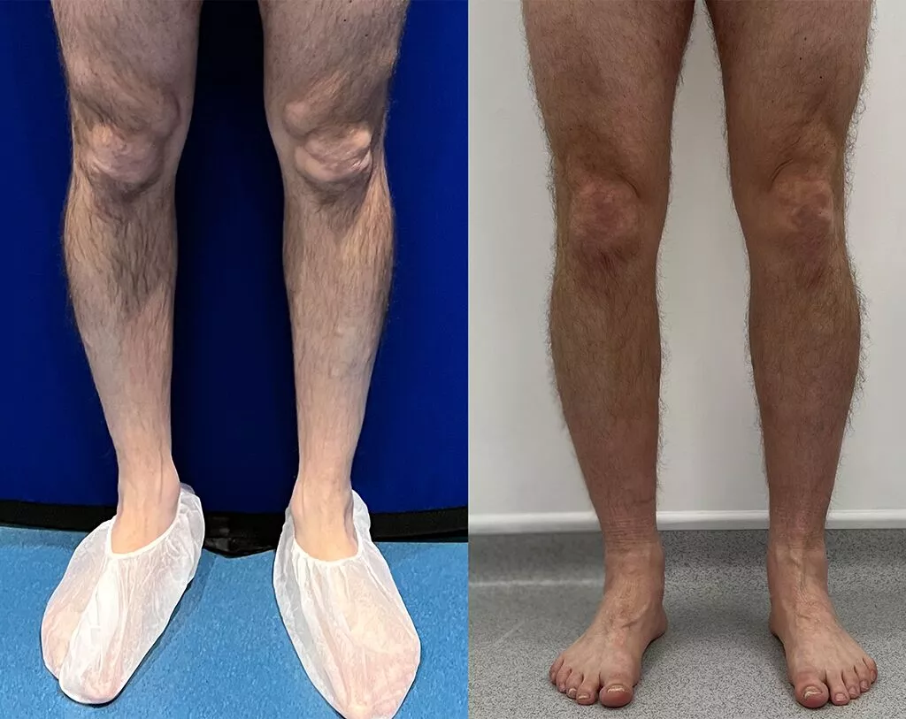 fat-transfer-calves-before-and-after-anterior-view.webp?format=webp&nv=ca64acd6-a6db-44c0-8ef1-3388dfd37a49