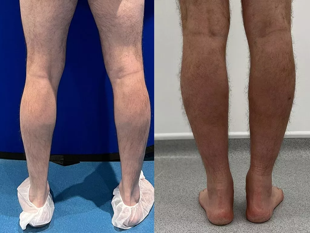 Get rid of calf discount fat