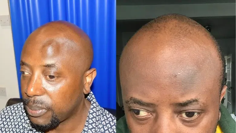 forehead-osteoma-removal-before-after-1.png.webp?format=webp&nv=ca64acd6-a6db-44c0-8ef1-3388dfd37a49