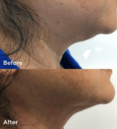 fotona 4d face neck skin tightening