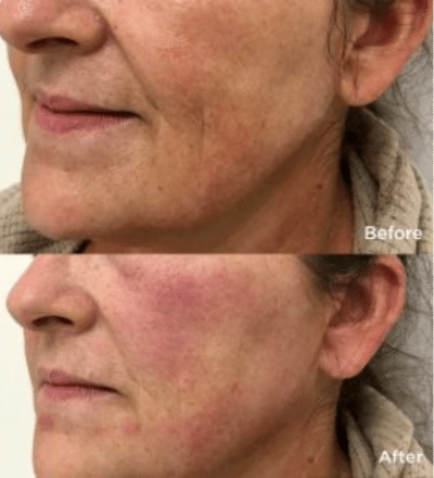 fotona 4d facial skin tightening