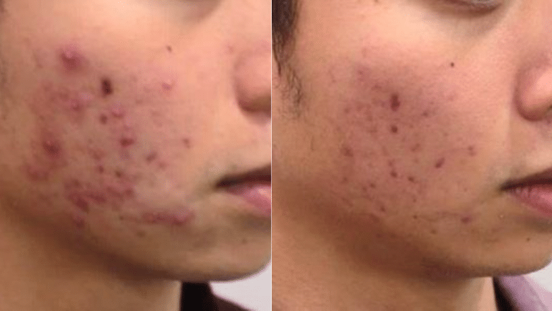 fotona acne laser treatment before after