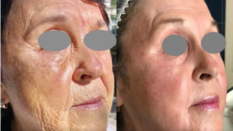 fotona-erbium-YAG-laser-skin-resurfacing-before-after.png.webp?format=webp&nv=212368fc-2000-40d1-9026-c0f94abda644