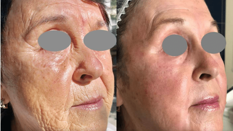 fotona erbium YAG laser skin resurfacing before after