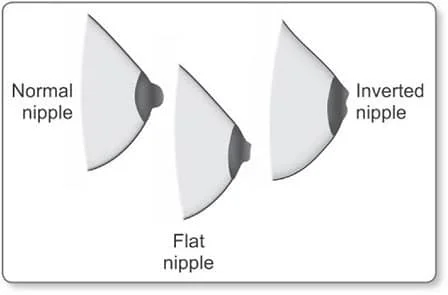 inverted nipple appearance