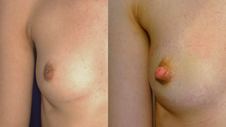 inverted nipple correction before after 1