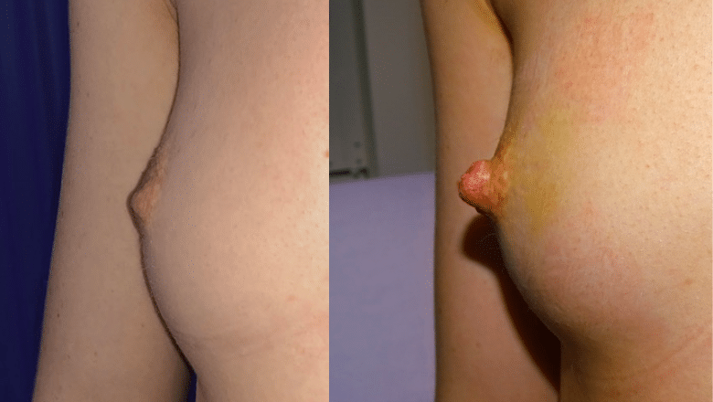 inverted nipple correction before after 2