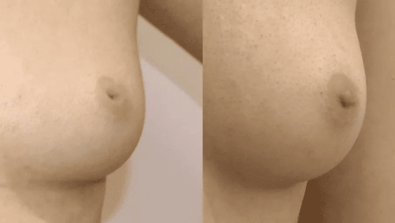 inverted nipple correction before after 7