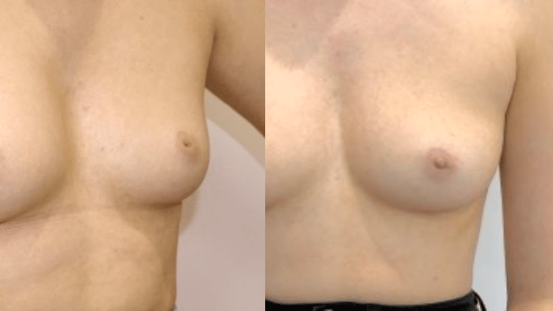 inverted nipple correction before after 6