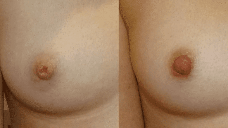 inverted nipple correction before after 8