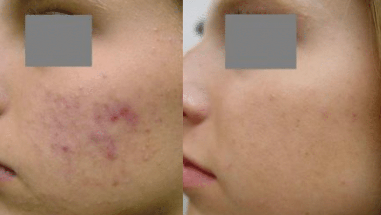 laser acne treatment before after