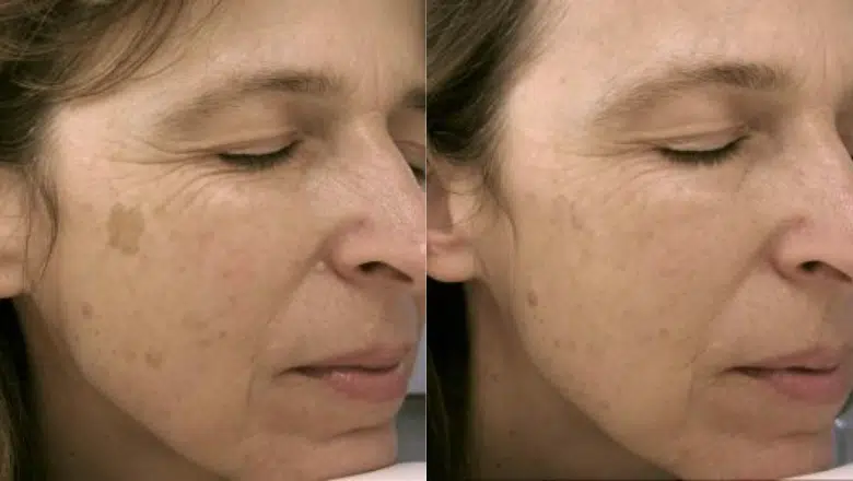 laser-age-spot-removal-before-after.png.webp?format=webp&nv=212368fc-2000-40d1-9026-c0f94abda644