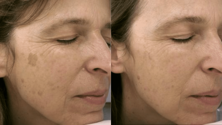 laser age spot removal before after